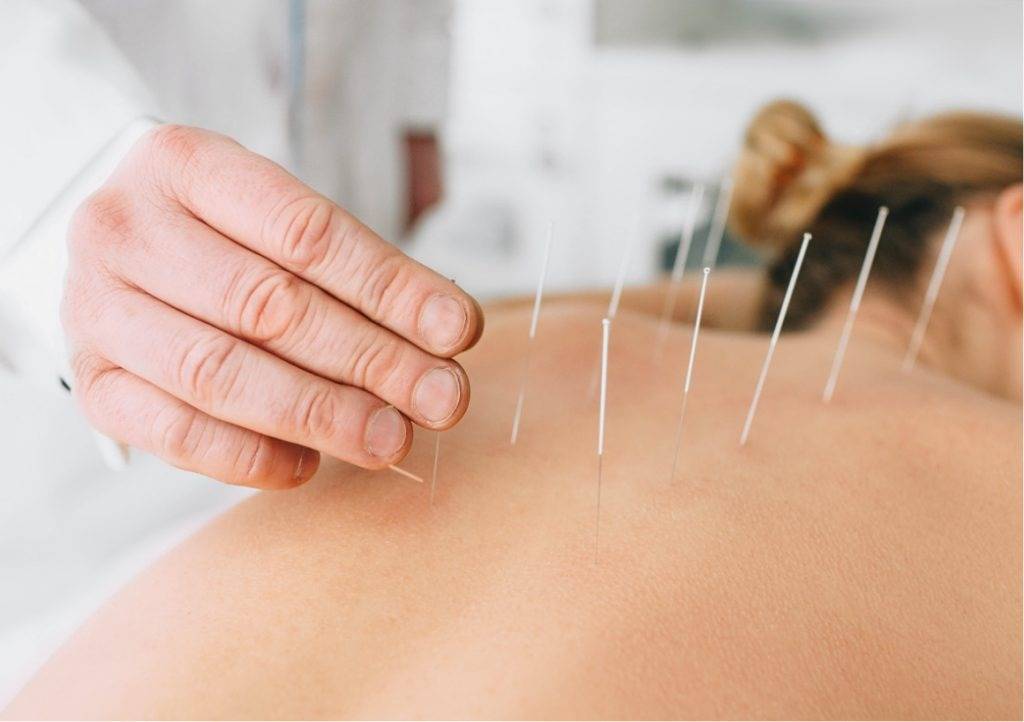 3 dry needling therapy nyc