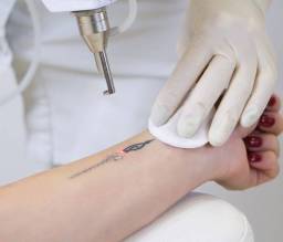2 laser tattoo removal near me Clermont